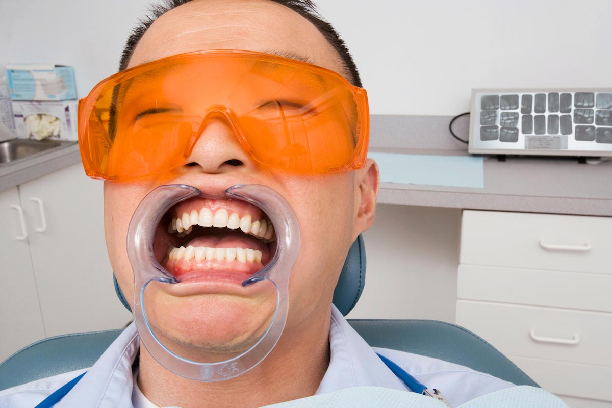 Man-Teeth-Whitening